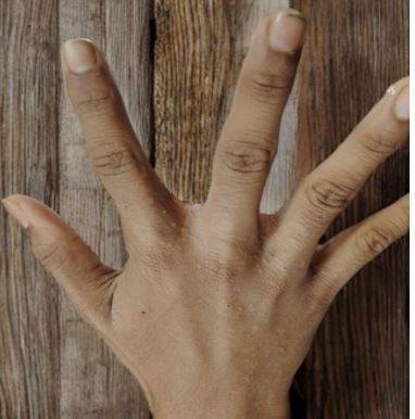 Epidemiological Investigation of Scabies Infestation in Dhaka Megacity, Bangladesh, 2024: Understand...