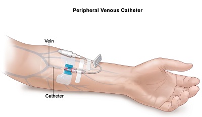 Peripheral Intravenous Catheter Complications in a Thai Tertiary Hospital: A Cross-Sectional Prevale...